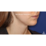 Ultherapy Before & After Patient #13329