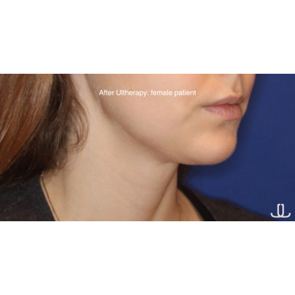 Ultherapy Before & After Patient #13329