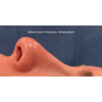 Revison Rhinoplasty Before & After Patient #15795