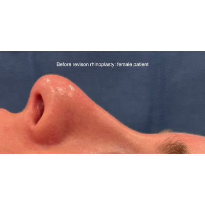 Revison Rhinoplasty Before & After Patient #15795