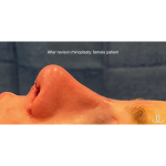 Revison Rhinoplasty Before & After Patient #15795