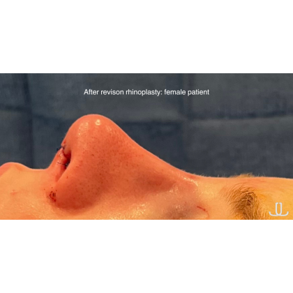 Revison Rhinoplasty Before & After Patient #15795