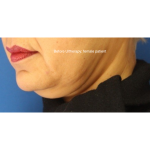 Ultherapy Before & After Patient #13336