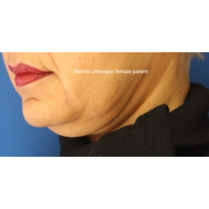 Ultherapy Before & After Patient #13336