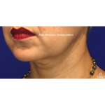 Ultherapy Before & After Patient #13336