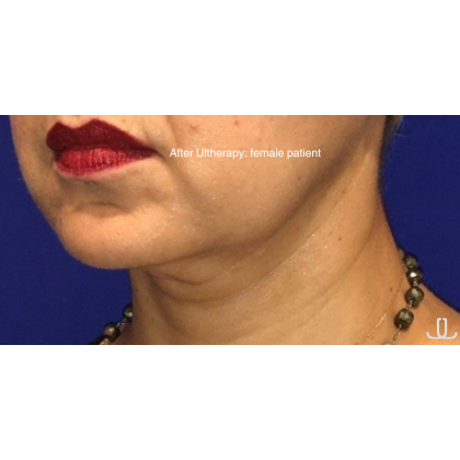 Ultherapy Before & After Patient #13336