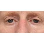 Otoplasty Before & After Patient #13920