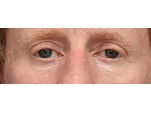 Otoplasty Before & After Patient #13920
