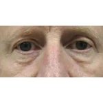 Otoplasty Before & After Patient #13920