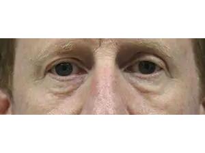 Otoplasty Before & After Patient #13920