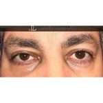 Otoplasty Before & After Patient #13913
