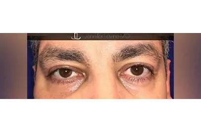 Otoplasty Before & After Patient #13913