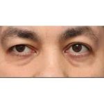 Otoplasty Before & After Patient #13913