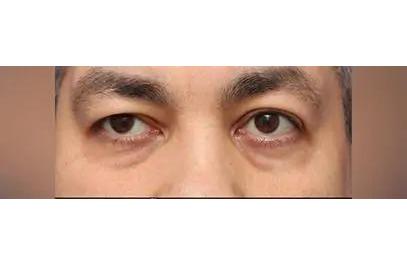 Otoplasty Before & After Patient #13913