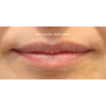Dermal Fillers Before & After Patient #15709