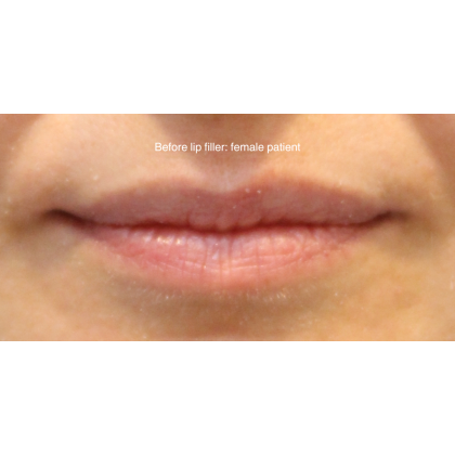 Dermal Fillers Before & After Patient #15709