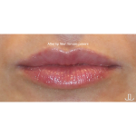 Dermal Fillers Before & After Patient #15709