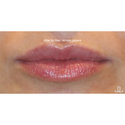 Dermal Fillers Before & After Patient #15709