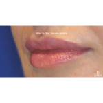 Dermal Fillers Before & After Patient #15709