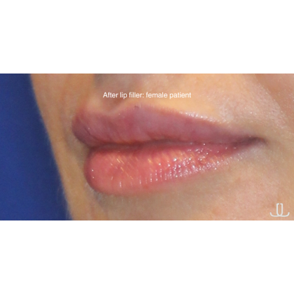 Dermal Fillers Before & After Patient #15709