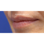 Dermal Fillers Before & After Patient #15709