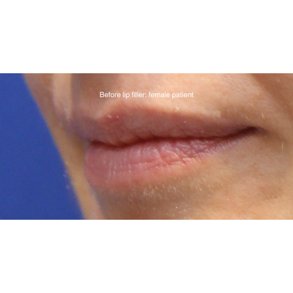 Dermal Fillers Before & After Patient #15709