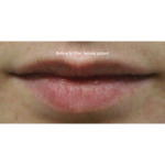 Dermal Fillers Before & After Patient #15710