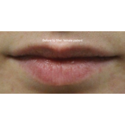 Dermal Fillers Before & After Patient #15710