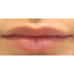 Dermal Fillers Before & After Patient #15710