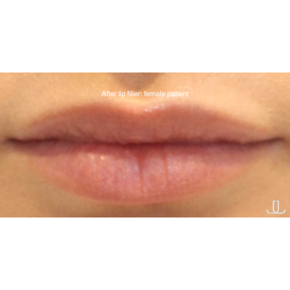 Dermal Fillers Before & After Patient #15710