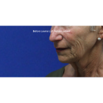 Facelift / Neck Lift Before & After Patient #15095