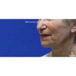 Facelift / Neck Lift Before & After Patient #15095