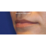 Lip Filler Before & After Patient #15387