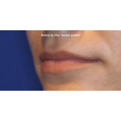 Lip Filler Before & After Patient #15387