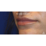 Lip Filler Before & After Patient #15387