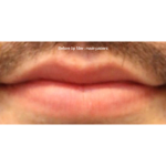 Lip Filler Before & After Patient #13834