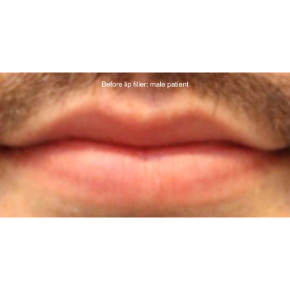 Lip Filler Before & After Patient #13834