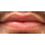 Lip Filler Before & After Patient #13834