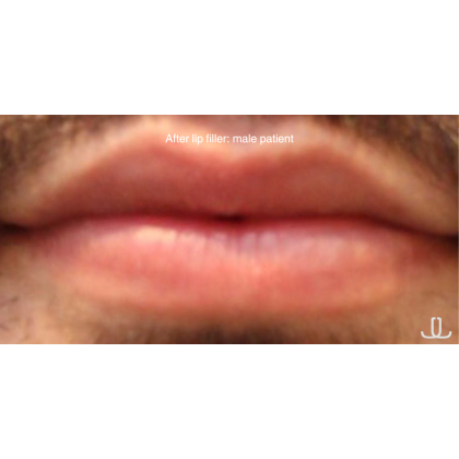 Lip Filler Before & After Patient #13834