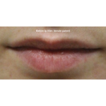 Lip Filler Before & After Patient #15386