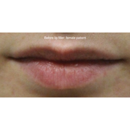 Lip Filler Before & After Patient #15386