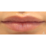 Lip Filler Before & After Patient #15386