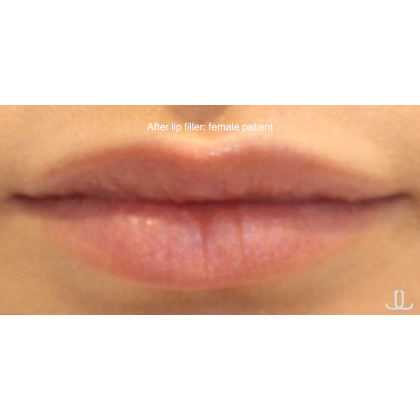 Lip Filler Before & After Patient #15386