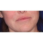 Lip Filler Before & After Patient #13827