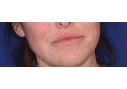 Lip Filler Before & After Patient #13827