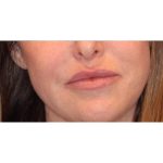 Lip Filler Before & After Patient #13827