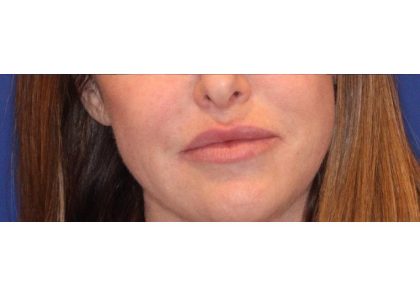 Lip Filler Before & After Patient #13827