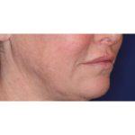 Lip Filler Before & After Patient #13827