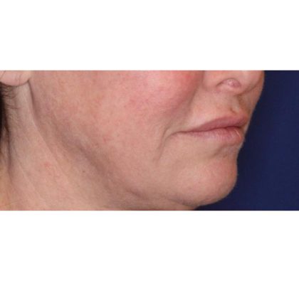 Lip Filler Before & After Patient #13827
