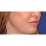 Lip Filler Before & After Patient #13827